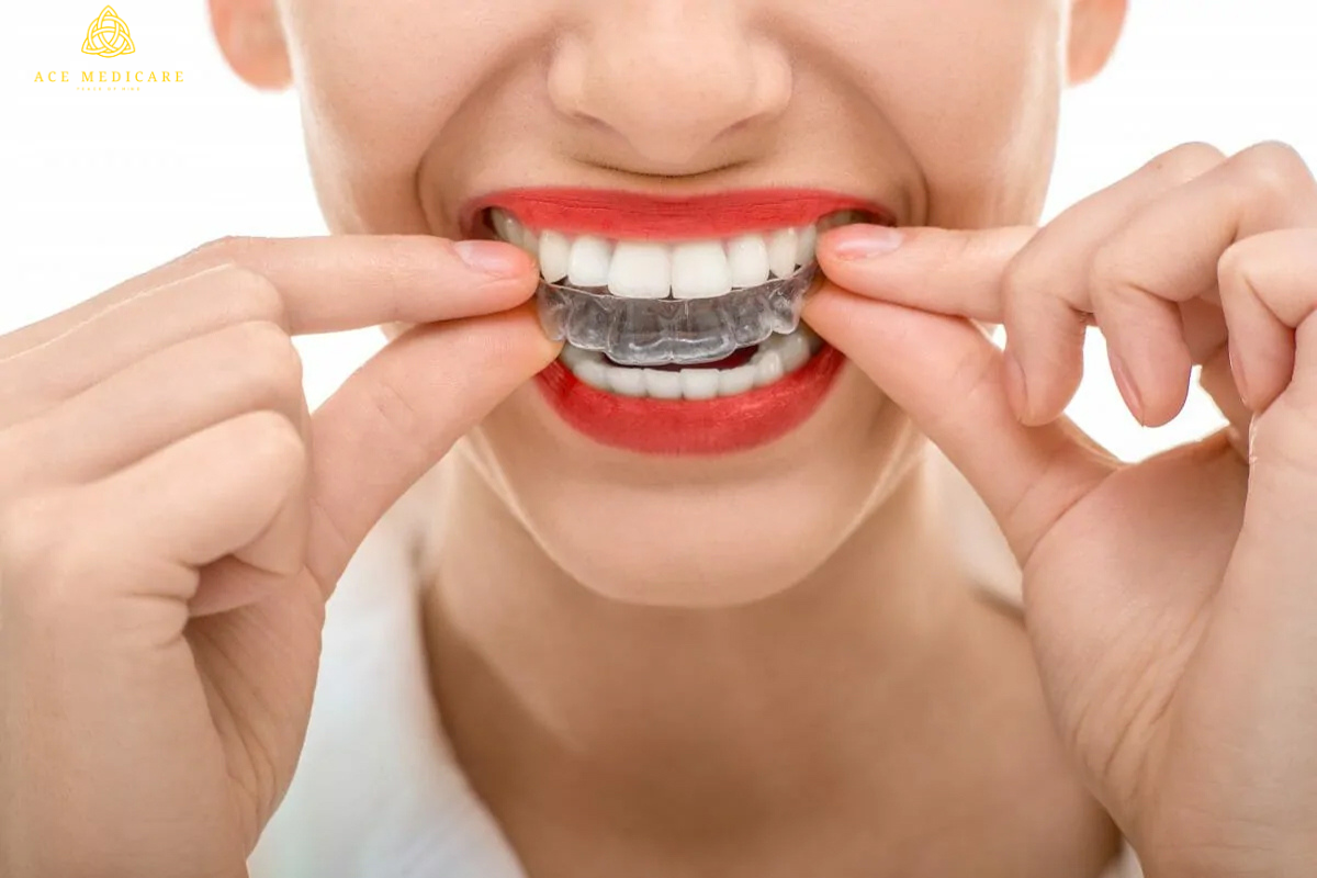 Clear Aligners vs. Traditional Braces: The Ultimate Showdown